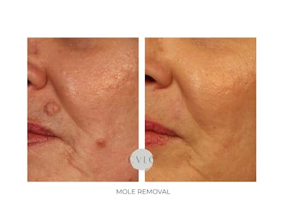 Mole Removal Before & After Gallery - Patient 121284 - Image 1