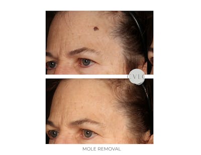 Mole Removal Before & After Gallery - Patient 748379 - Image 1