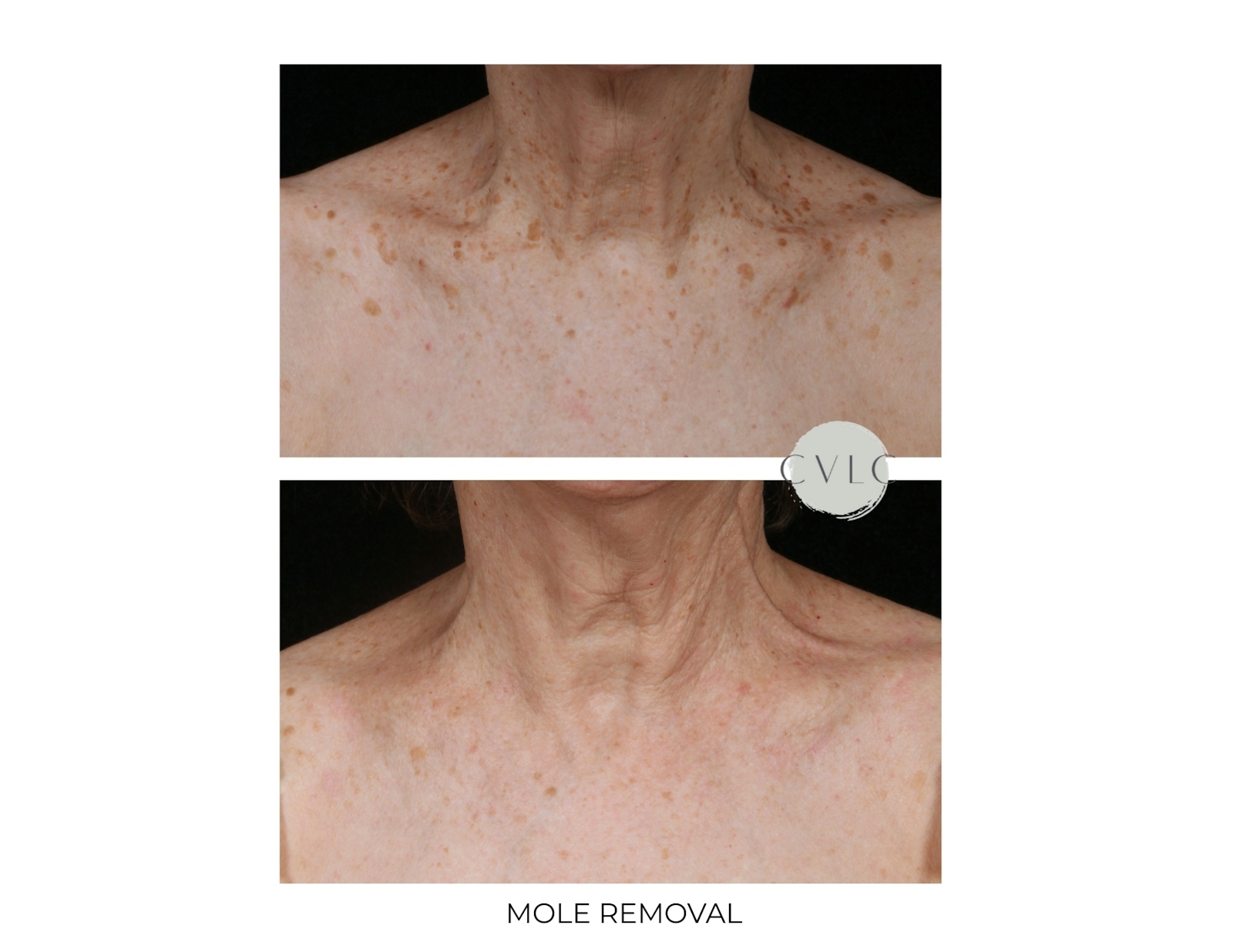 Mole Removal Before & After Gallery - Patient 201280 - Image 1