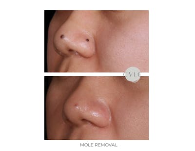 Mole Removal Before & After Gallery - Patient 256246 - Image 1