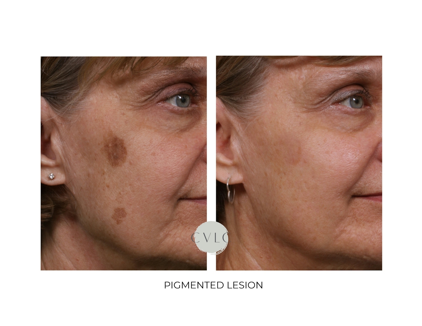 Pigmented Lesions Old Gallery Before & After Gallery - Patient 132249 - Image 1