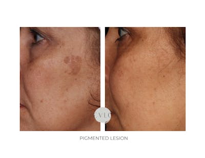 Pigmented Lesions Old Gallery Before & After Gallery - Patient 233637 - Image 1