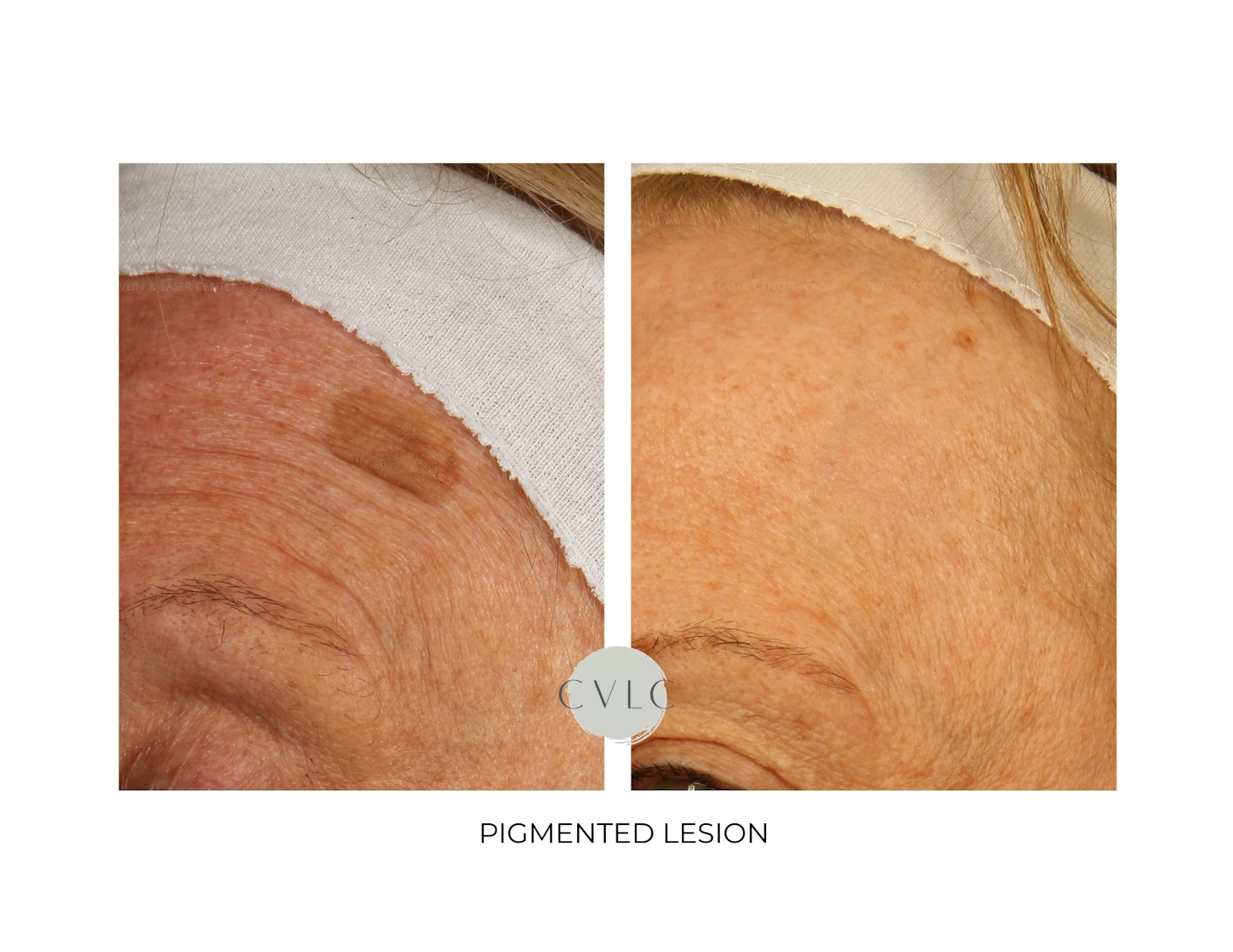 Pigmented Lesions Old Gallery Before & After Gallery - Patient 815518 - Image 1