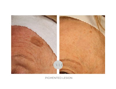 Pigmented Lesions Old Gallery Before & After Gallery - Patient 815518 - Image 1