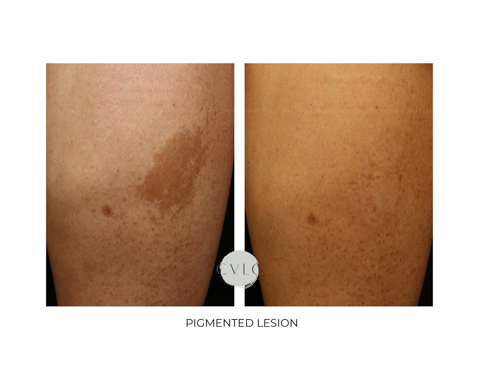 Pigmented Lesions Old Gallery Before & After Gallery - Patient 343977 - Image 1