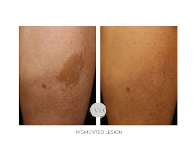 Pigmented Lesions Old Gallery Before & After Gallery - Patient 343977 - Image 1