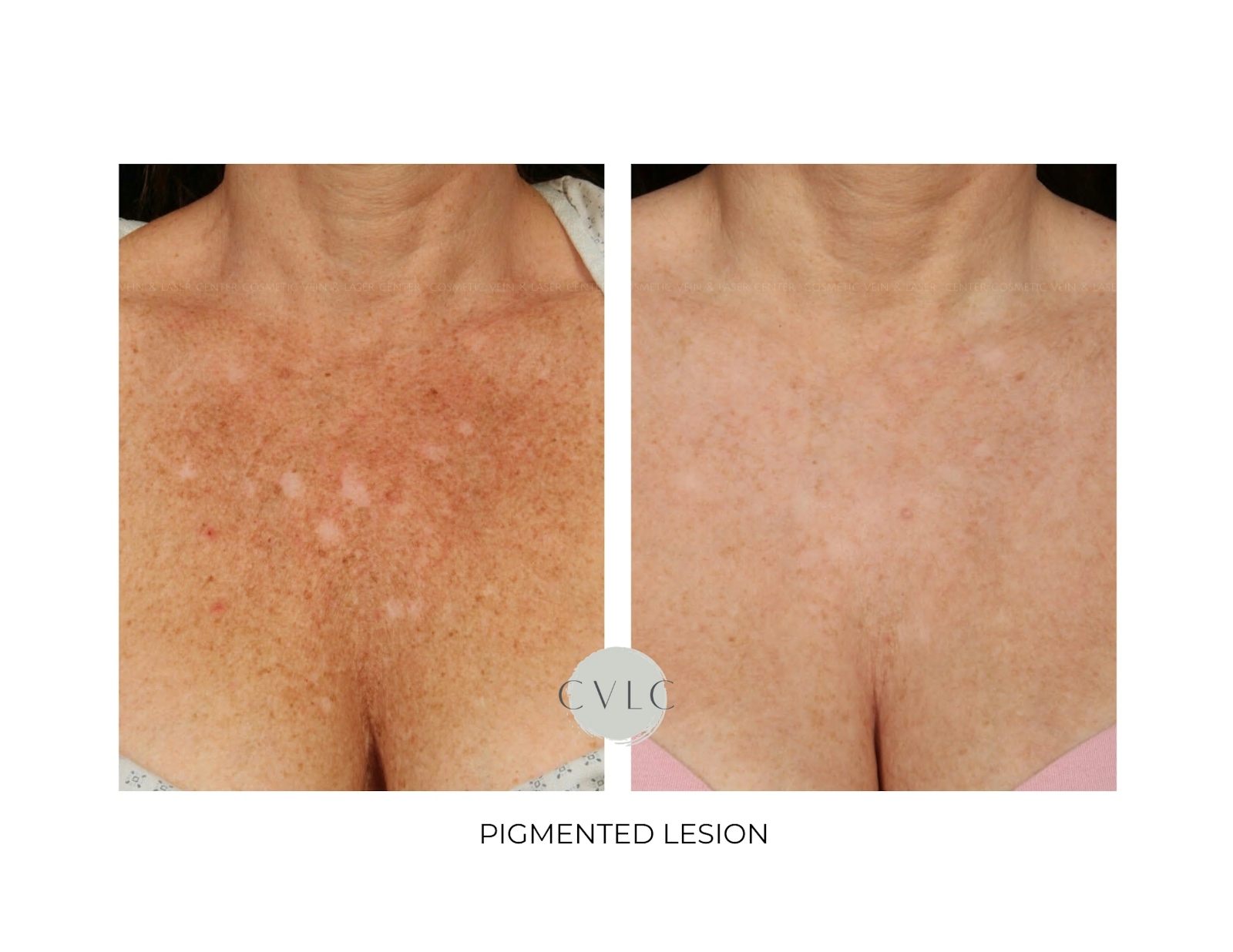 Pigmented Lesions Old Gallery Before & After Gallery - Patient 226535 - Image 1