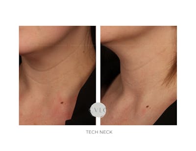 Neck Rejuvenation Before & After Gallery - Patient 344599 - Image 1