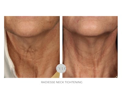 Neck Rejuvenation Before & After Gallery - Patient 550389 - Image 1