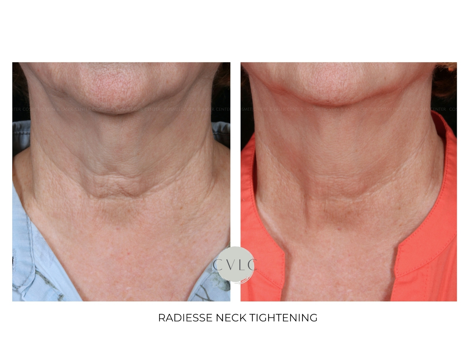 Neck Rejuvenation Before & After Gallery - Patient 187797 - Image 1