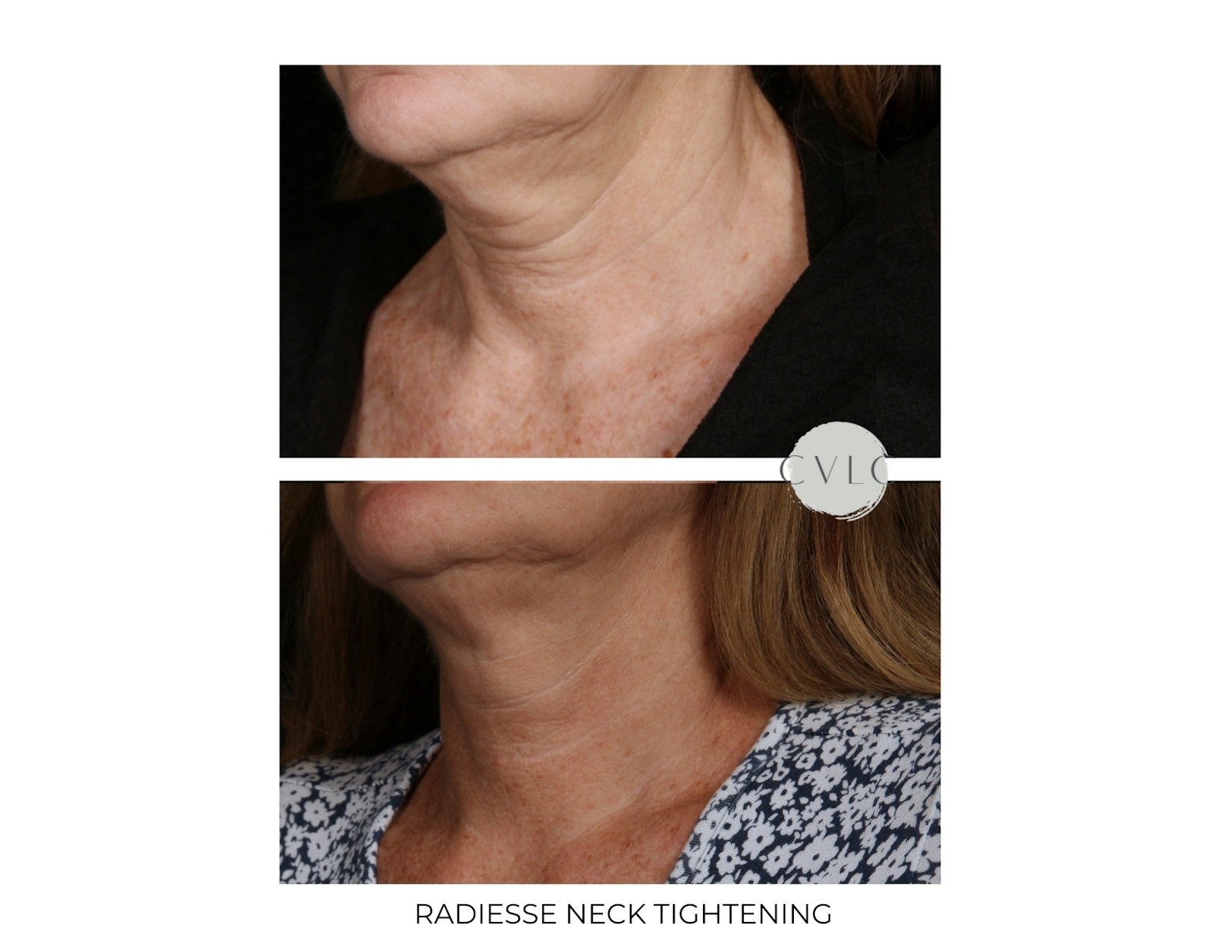Neck Rejuvenation Before & After Gallery - Patient 261542 - Image 1