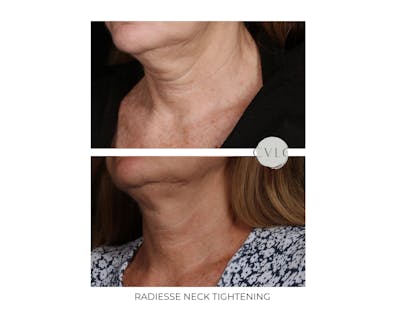 Neck Rejuvenation Before & After Gallery - Patient 261542 - Image 1