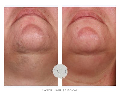 Laser Hair Removal Before & After Gallery - Patient 295637 - Image 1