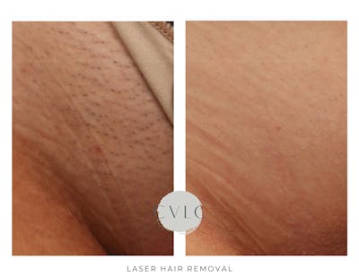 Laser Hair Removal Before & After Gallery - Patient 191393 - Image 1