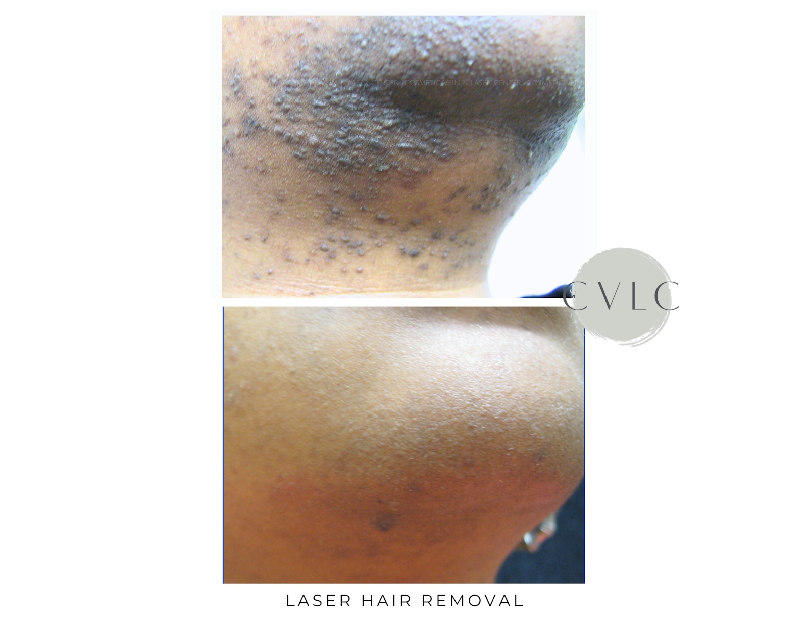 Laser Hair Removal Before & After Gallery - Patient 624244 - Image 1