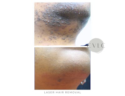 Laser Hair Removal Before & After Gallery - Patient 624244 - Image 1