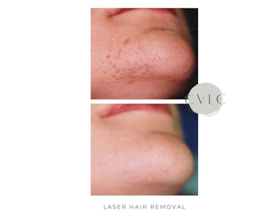 Laser Hair Removal Before & After Gallery - Patient 686805 - Image 1