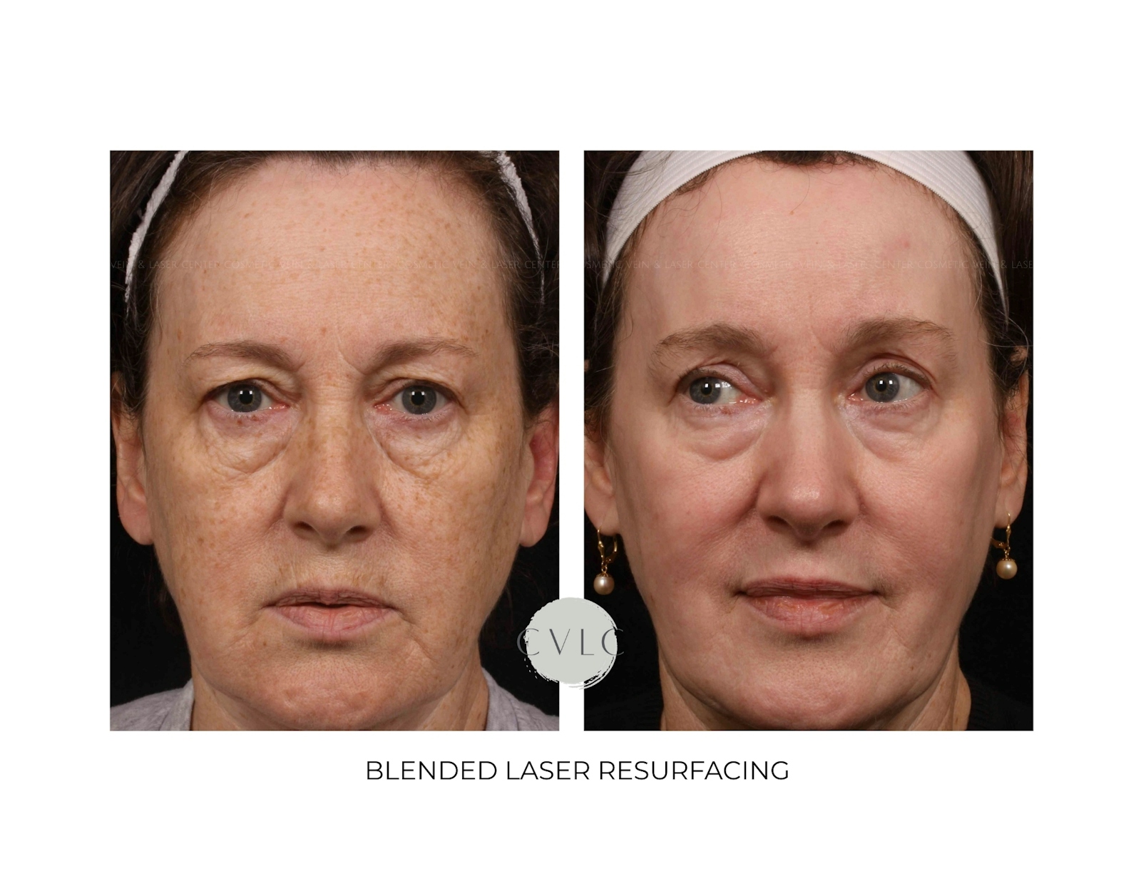 Ablative Laser Resurfacing Before & After Gallery - Patient 307011 - Image 1