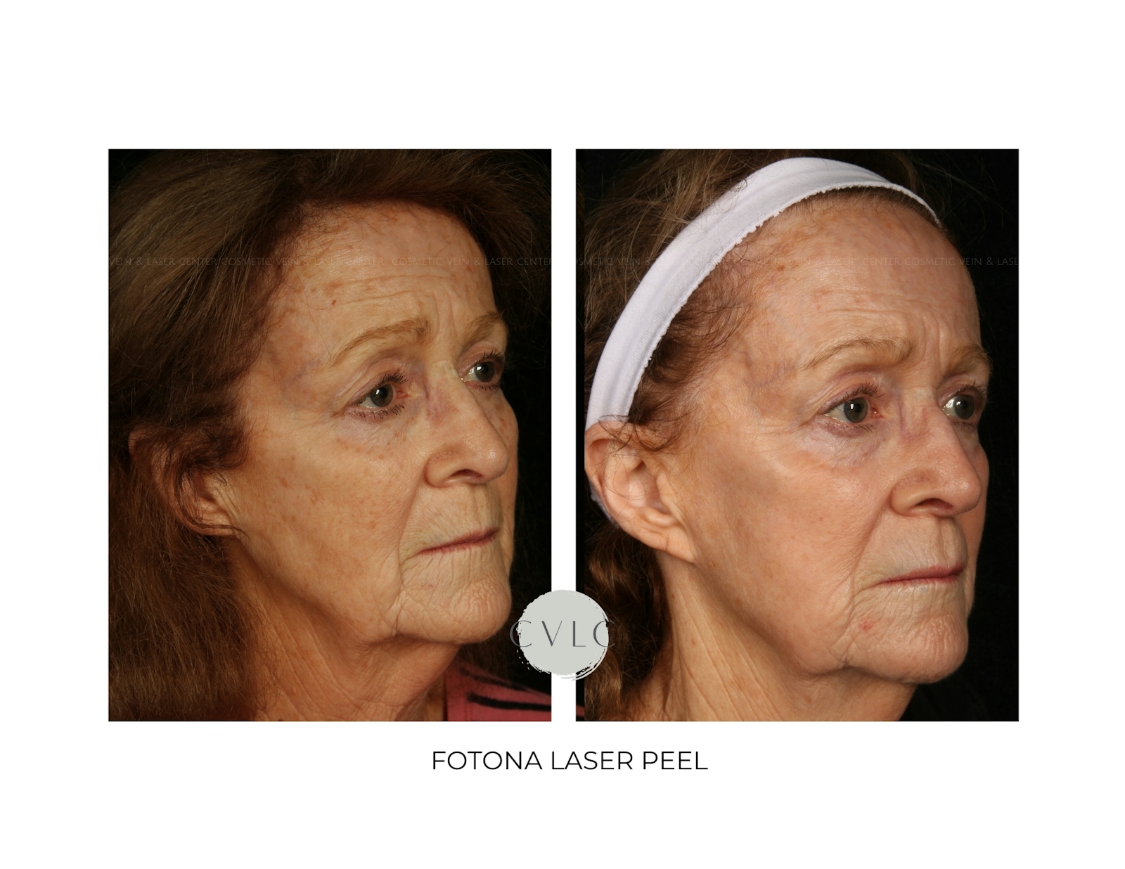 Ablative Laser Resurfacing Before & After Gallery - Patient 281532 - Image 1