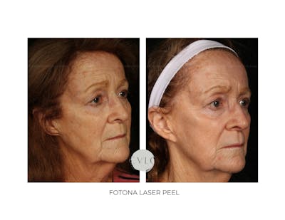 Ablative Laser Resurfacing Before & After Gallery - Patient 281532 - Image 1