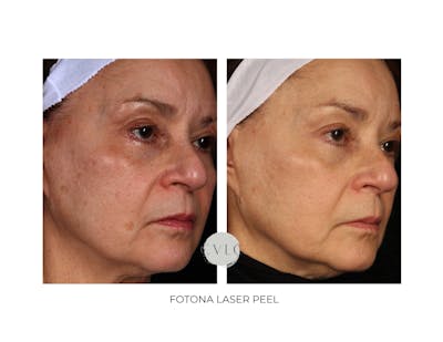 Ablative Laser Resurfacing Before & After Gallery - Patient 386420 - Image 1