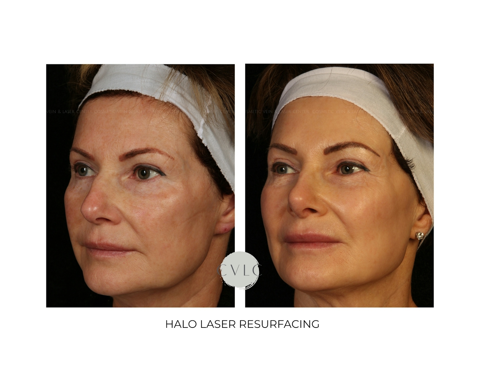 Ablative Laser Resurfacing Before & After Gallery - Patient 100335 - Image 1