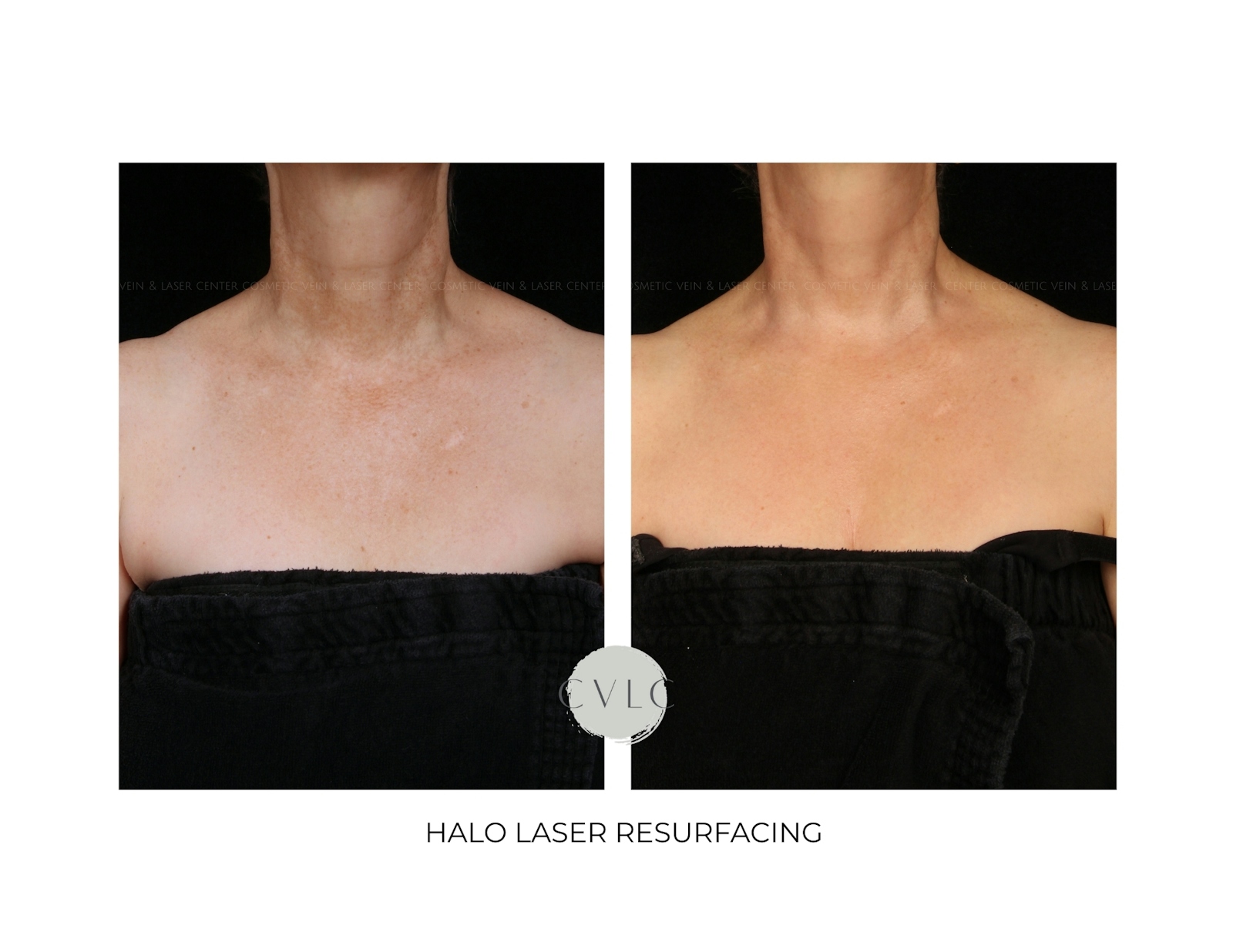 Ablative Laser Resurfacing Before & After Gallery - Patient 860994 - Image 1