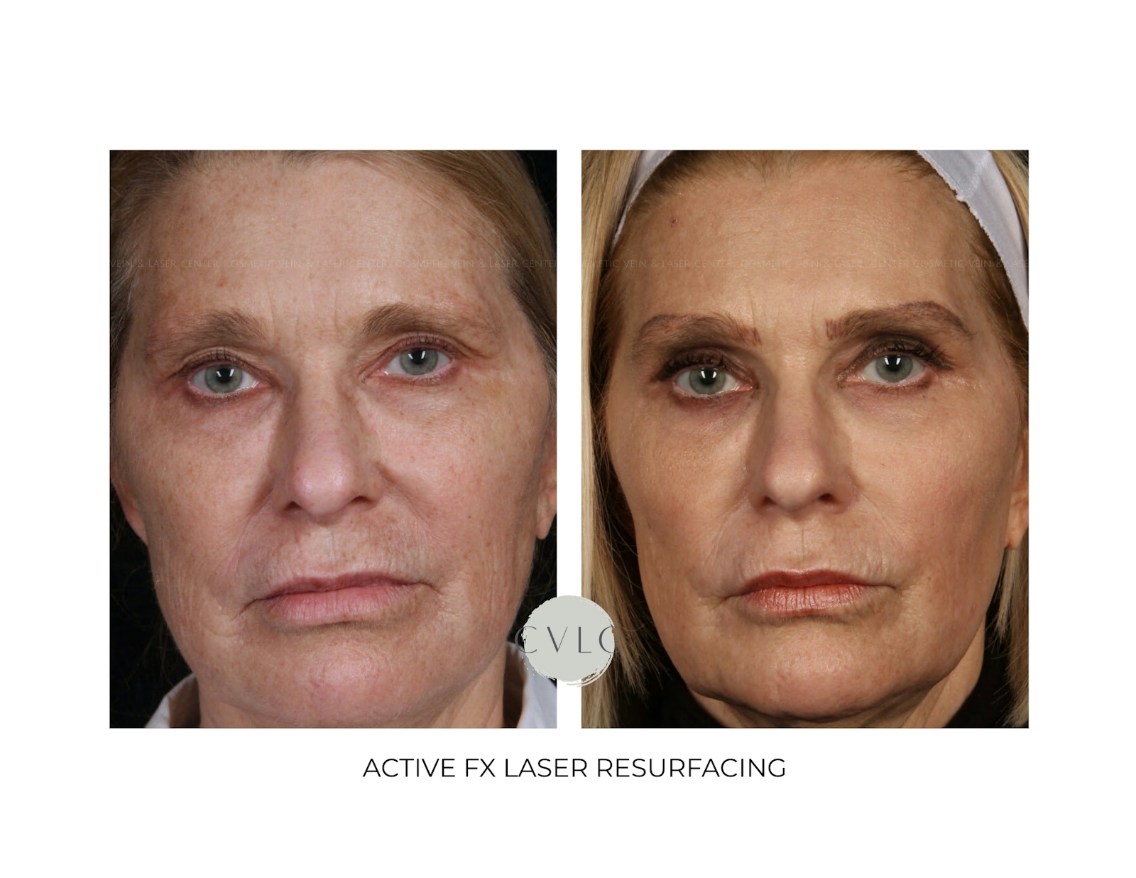Ablative Laser Resurfacing Before & After Gallery - Patient 166172 - Image 1