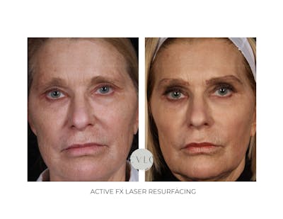 Ablative Laser Resurfacing Before & After Gallery - Patient 166172 - Image 1