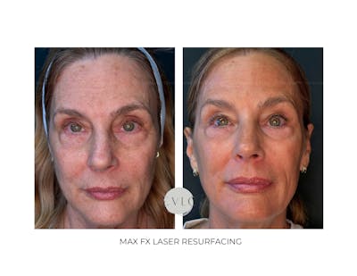 Ablative Laser Resurfacing Before & After Gallery - Patient 988980 - Image 1