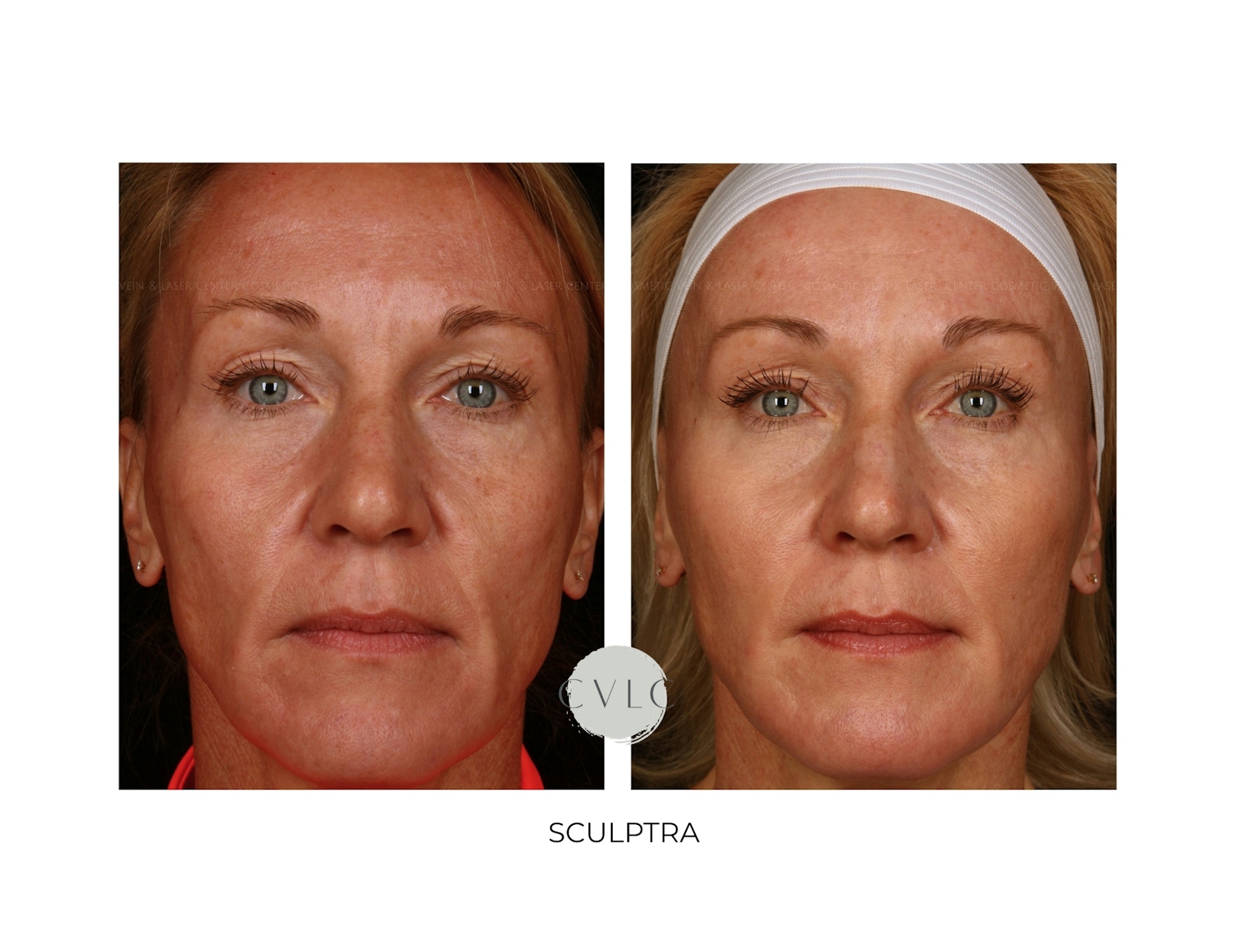 Sculptra Before & After Gallery - Patient 269341 - Image 1