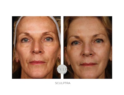 Sculptra Before & After Gallery - Patient 378200 - Image 1