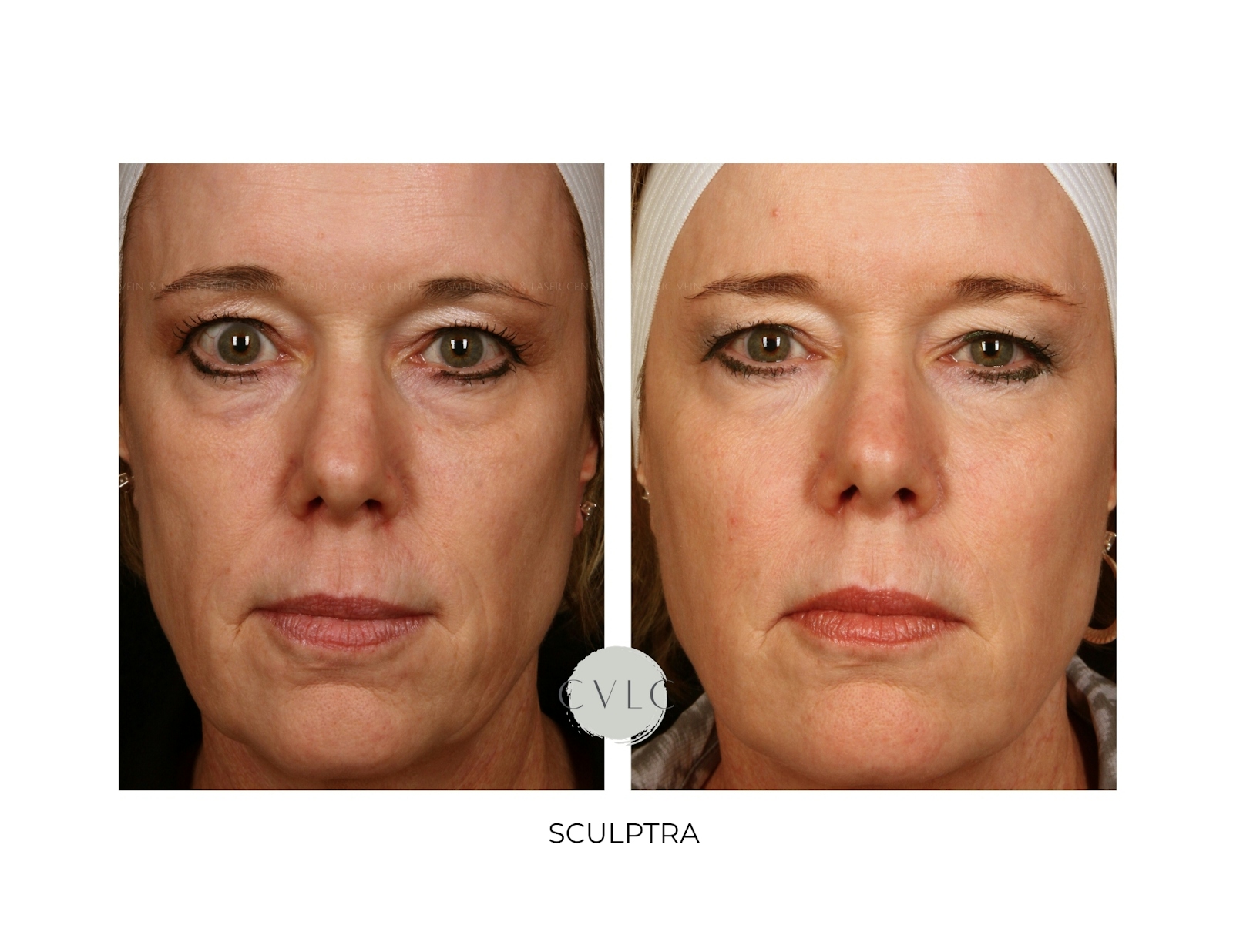 Sculptra Before & After Gallery - Patient 249042 - Image 1