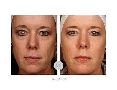 Sculptra Before & After Gallery - Patient 249042 - Image 1