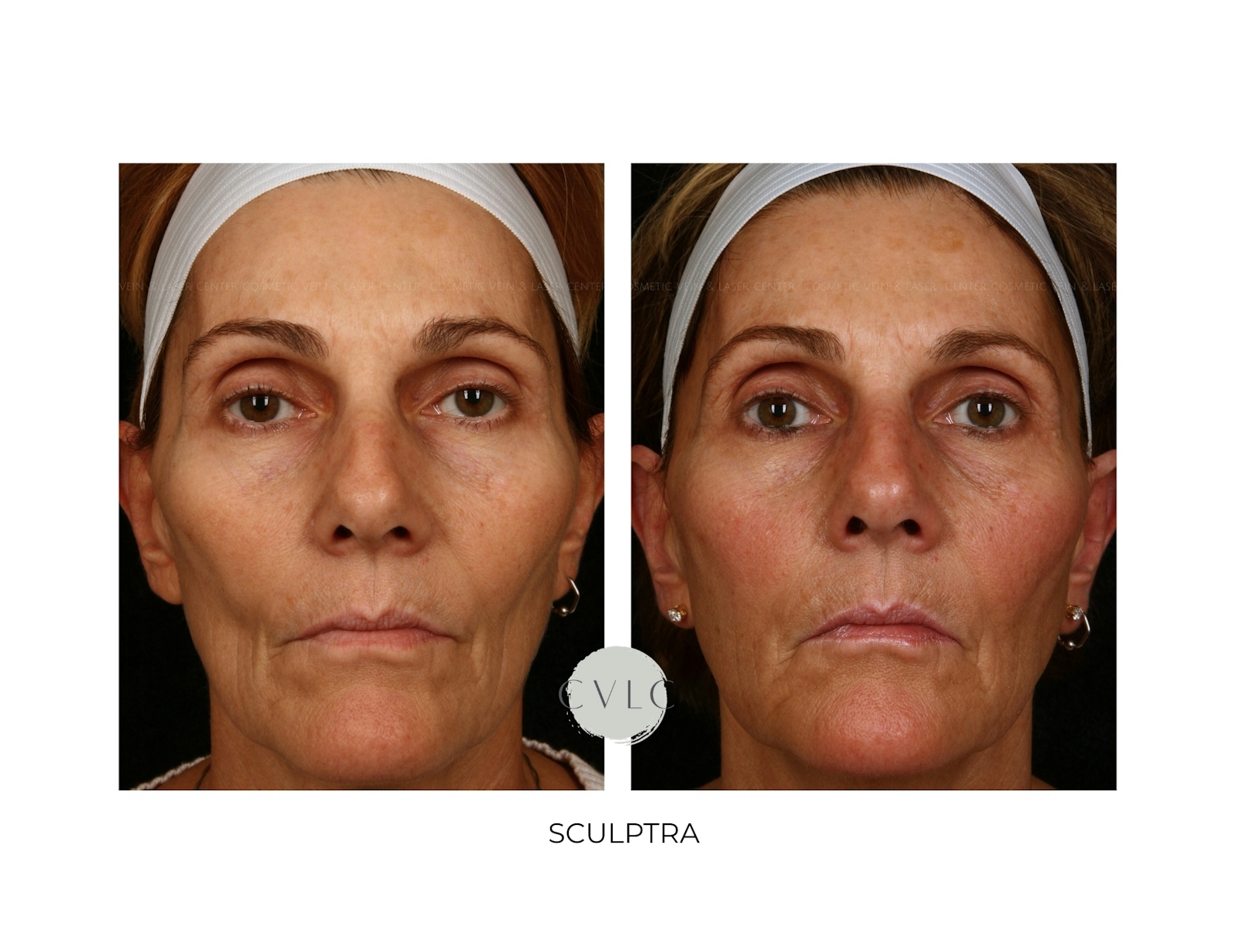Sculptra Before & After Gallery - Patient 322832 - Image 1