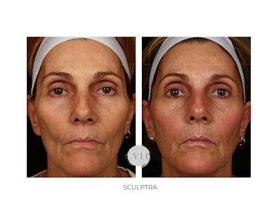 Sculptra Before & After Gallery - Patient 322832 - Image 1
