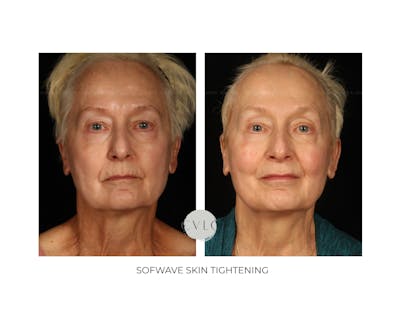 Sofwave Skin Tightening  Before & After Gallery - Patient 351202 - Image 1