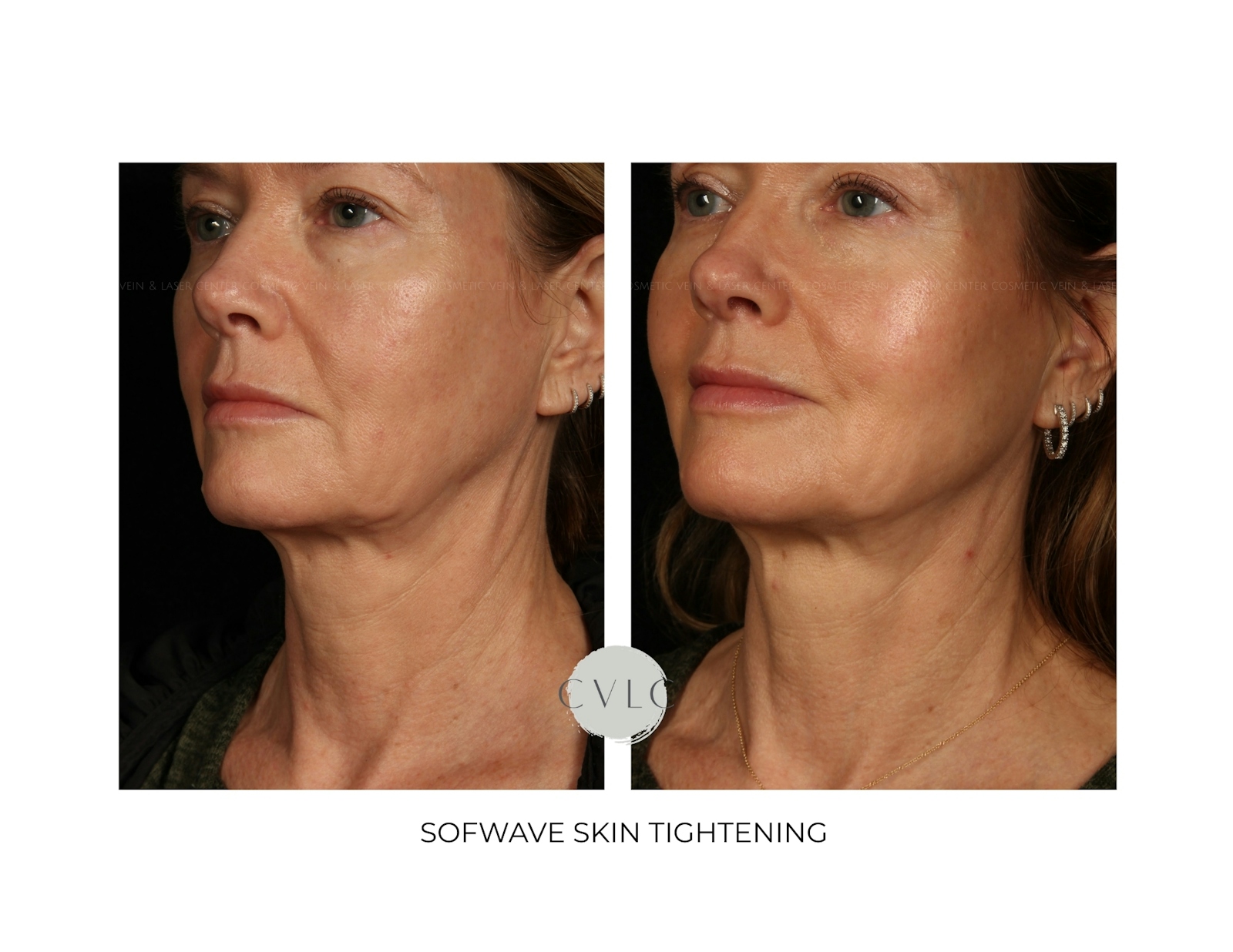 Sofwave Skin Tightening  Before & After Gallery - Patient 244391 - Image 1