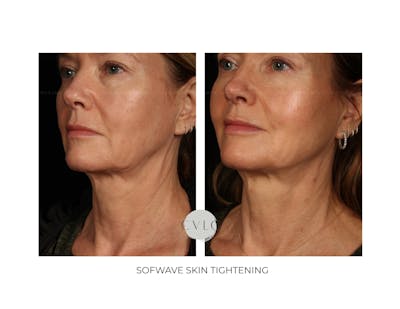 Sofwave Skin Tightening  Before & After Gallery - Patient 244391 - Image 1