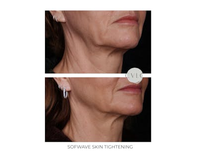 Sofwave Skin Tightening  Before & After Gallery - Patient 293119 - Image 1