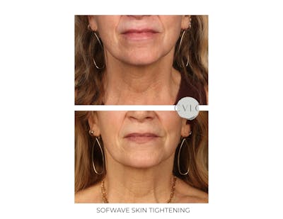 Sofwave Skin Tightening  Before & After Gallery - Patient 273823 - Image 1