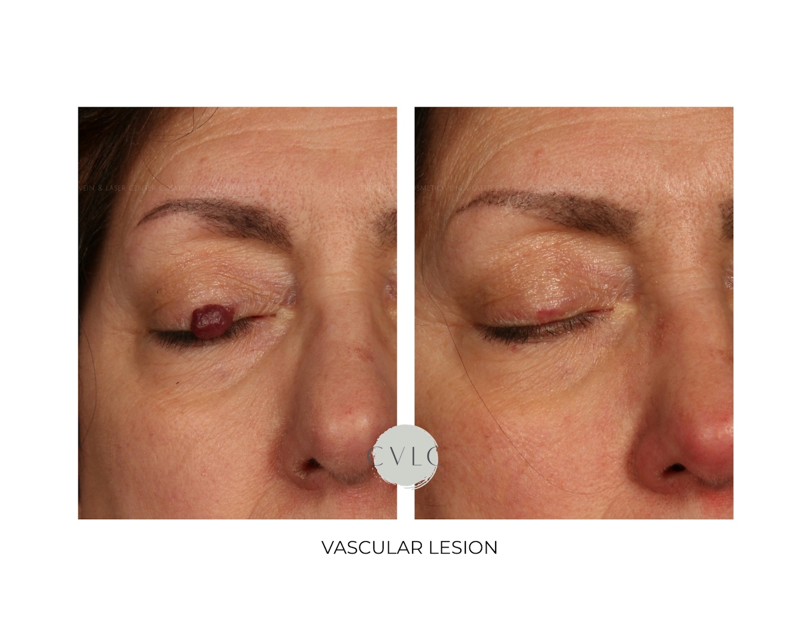 Vascular Lesions Before & After Gallery - Patient 162111 - Image 1