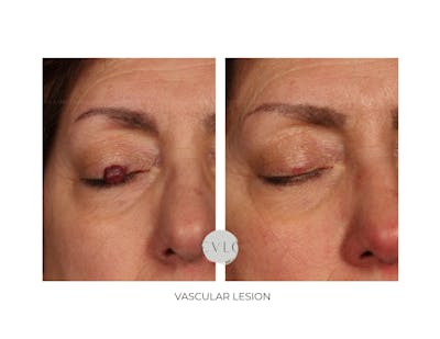 Vascular Lesions Before & After Gallery - Patient 162111 - Image 1