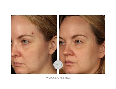 Vascular Lesions Before & After Gallery - Patient 105866 - Image 1