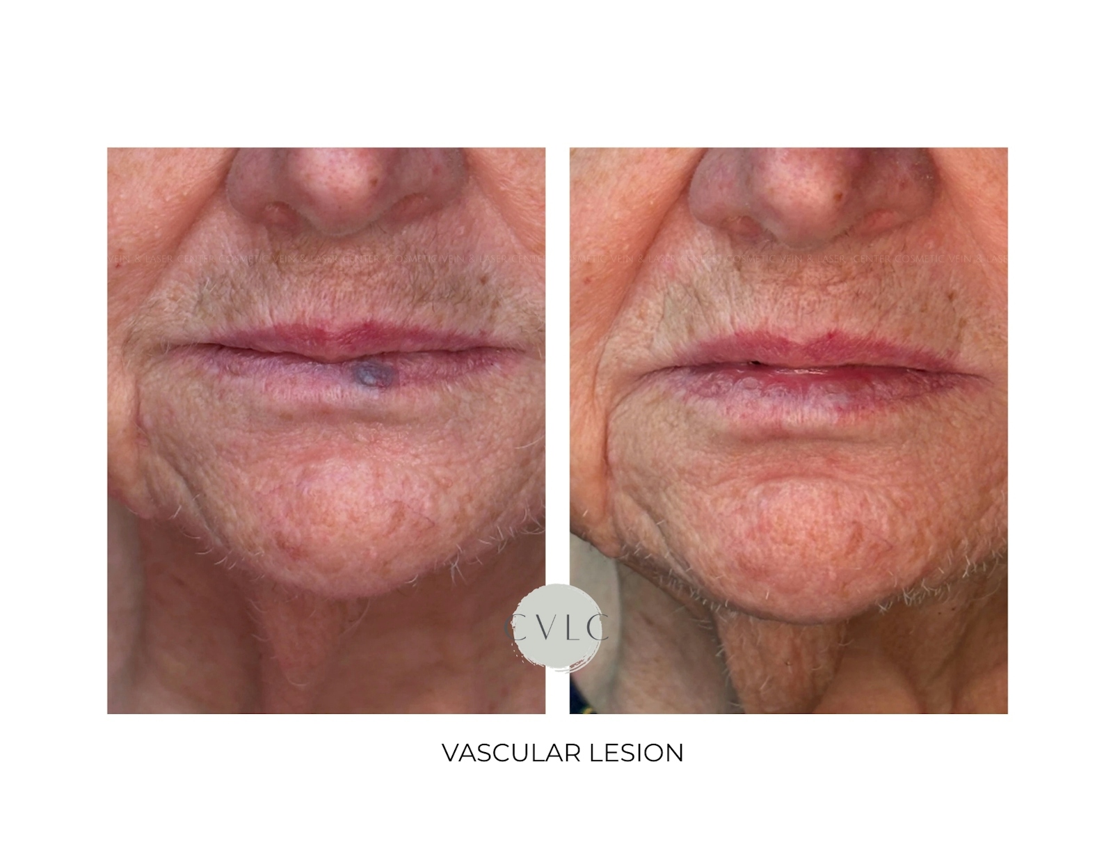 Vascular Lesions Before & After Gallery - Patient 202714 - Image 1