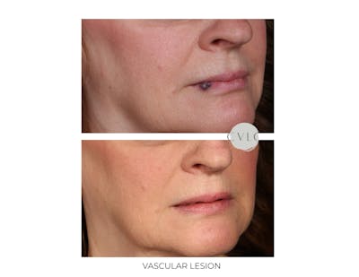 Vascular Lesions Before & After Gallery - Patient 396990 - Image 1
