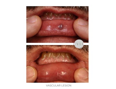 Vascular Lesions Before & After Gallery - Patient 230603 - Image 1