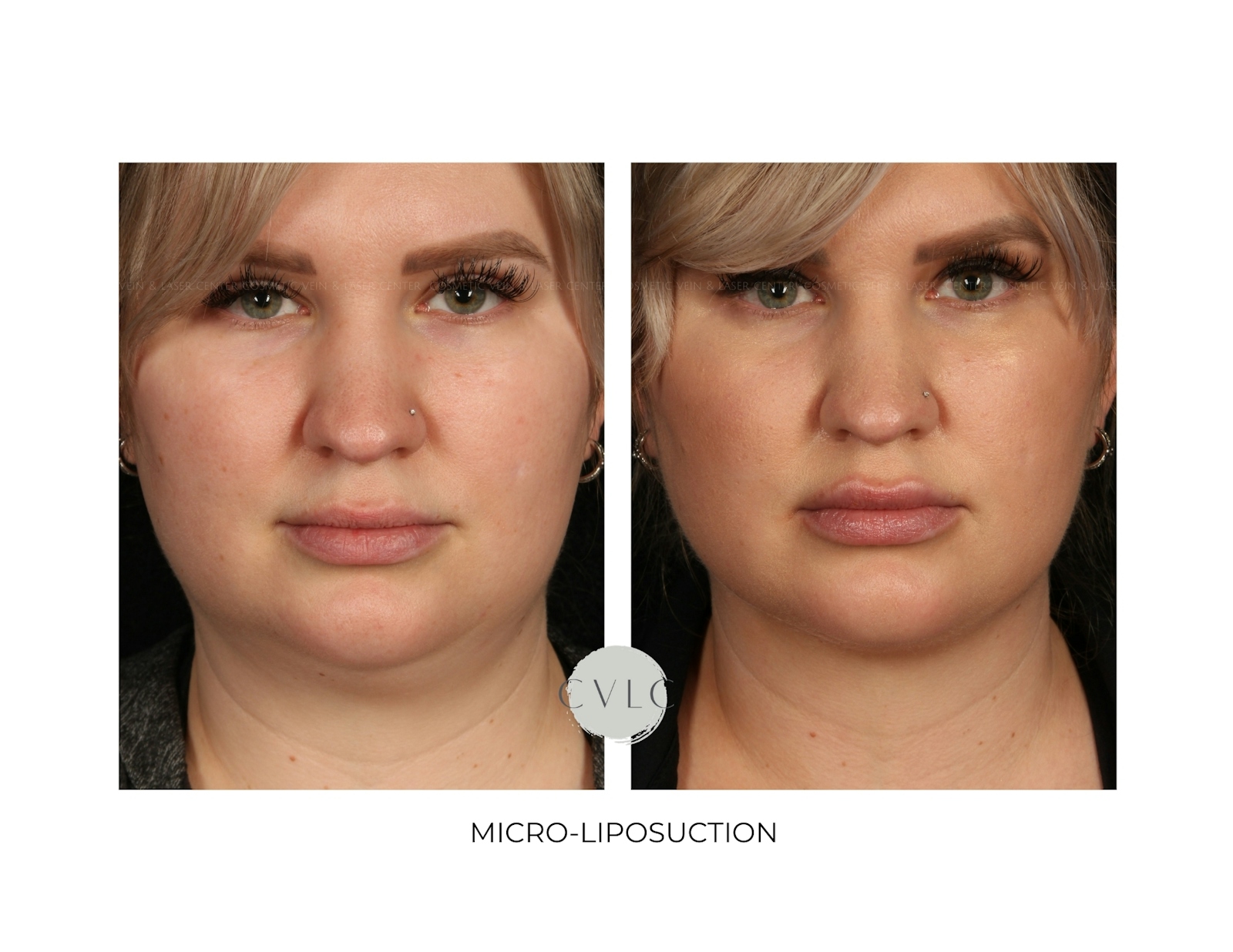 Micro-Liposuction Before & After Gallery - Patient 423034 - Image 1