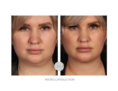Micro-Liposuction Before & After Gallery - Patient 423034 - Image 1