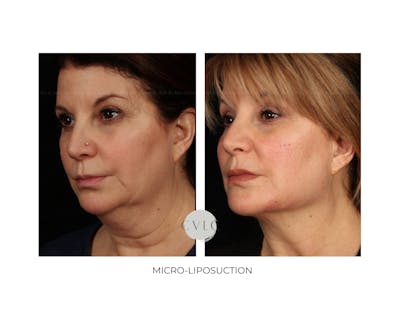 Micro-Liposuction Before & After Gallery - Patient 417915 - Image 1